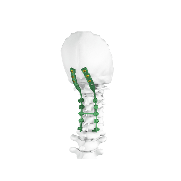 Occipito - Cervico - Thoracic (OCT) Spine System