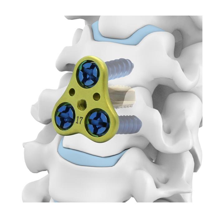Anterior cervical fusion with the cage-plate system