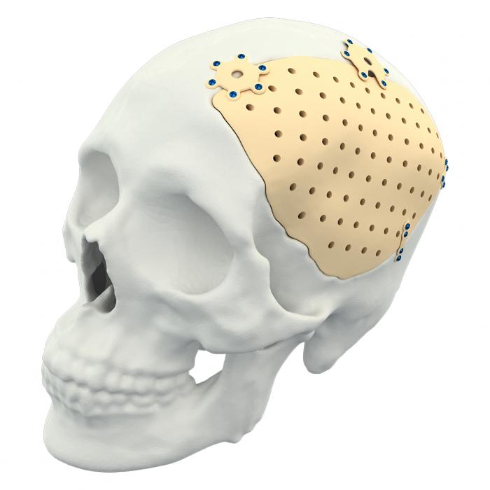 PSI Cranial Implant
