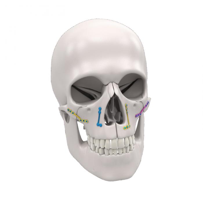 Orthognathic Fixation System