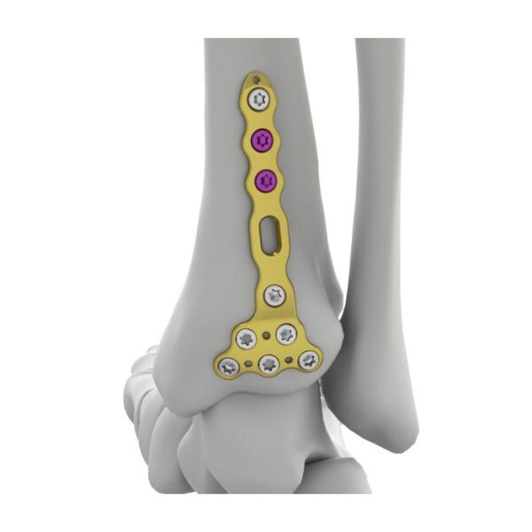Placa de Bloqueio Tibial Posterior Distal Itval