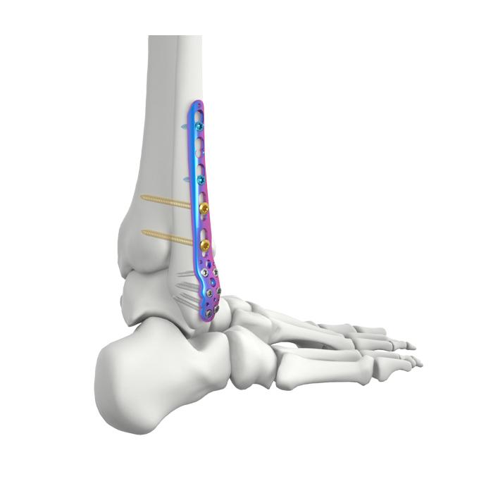 Placa de Bloqueio Fibular Lateral Distal VAL