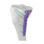 Placa de Bloqueio Tibial Medial Proximal VAL