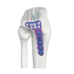 VAL Placa de Fixação DR Tibial Lateral Proximal
