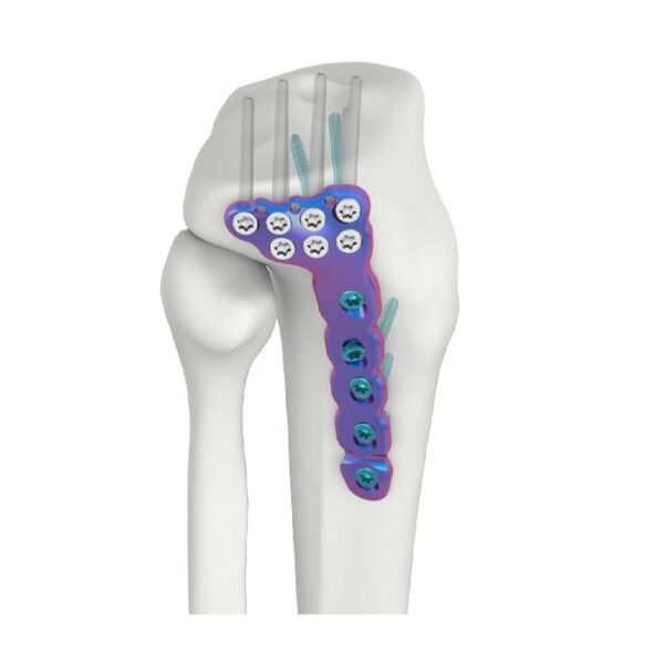 VAL Placa de Fixação DR Tibial Lateral Proximal