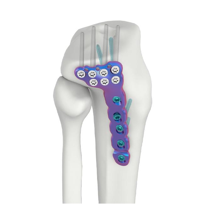 VAL Placa de Fixação DR Tibial Lateral Proximal