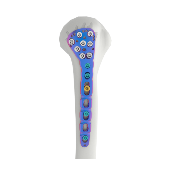 A Placa de Fixação Proximal do Úmero VAL é usada para fraturas do úmero proximal, incluindo fratura complexa, fratura com luxação, não união óssea e