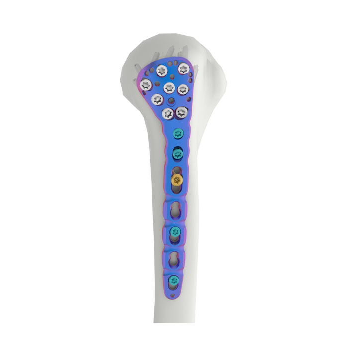 A Placa de Fixação Proximal do Úmero VAL é usada para fraturas do úmero proximal, incluindo fratura complexa, fratura com luxação, não união óssea e