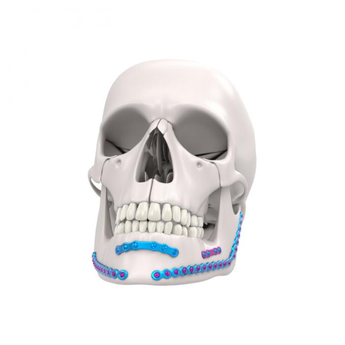 Sistema de Fixação Mandibular