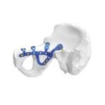 Placa de Fixação Acetabular Pélvica Anatômica