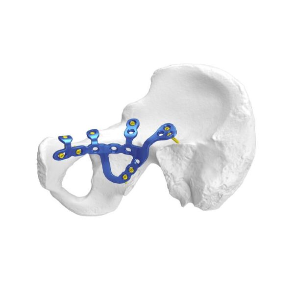 Placa de Fixação Acetabular Pélvica Anatômica