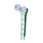 Placa de Bloqueio Femoral Proximal