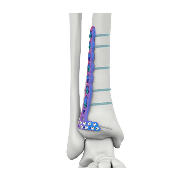 VAL Placa de Fixação Tibial Lateral Anterior Distal