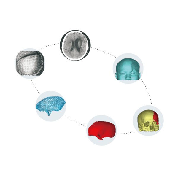 Patient Specific Implant - PSI
