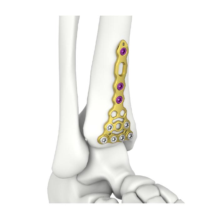 Itval Distal Anterior Tibial Locking Plate