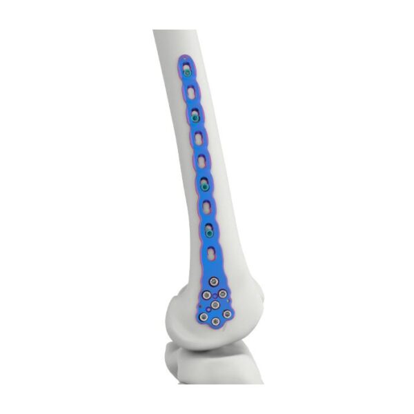Placa de Bloqueio Femoral Distal VAL
