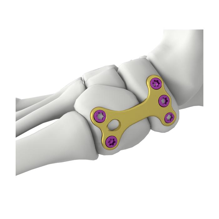 Placa de Bloqueio para Fusão Navicular-Cuneiforme Itval