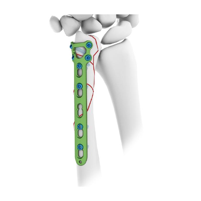 Placa de Bloqueio Ulnar Distal