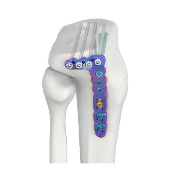 Placa de Bloqueio SR Proximal Lateral da Tíbia VAL – Curvatura Baixa