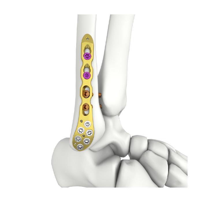 Placa de Bloqueio Fibular Lateral Distal Itval