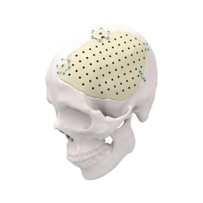 Implante Personalizado Específico para o Paciente em PEEK e Titânio para Reparo e Construção Craniana