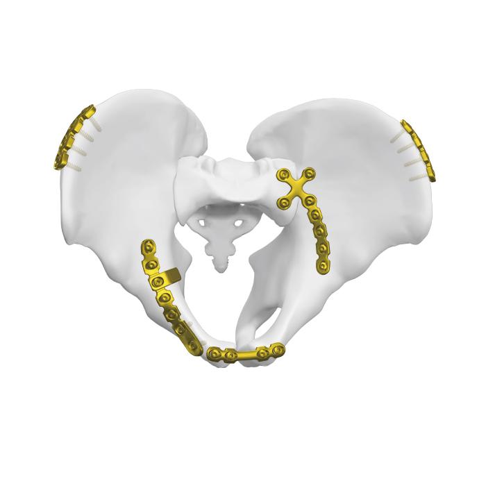 Placa Quadrangular da Superfície Posterior